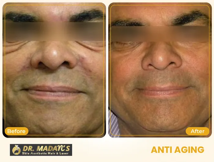 Anti aging before and after result 3 at Dr Madan Aesthetics
